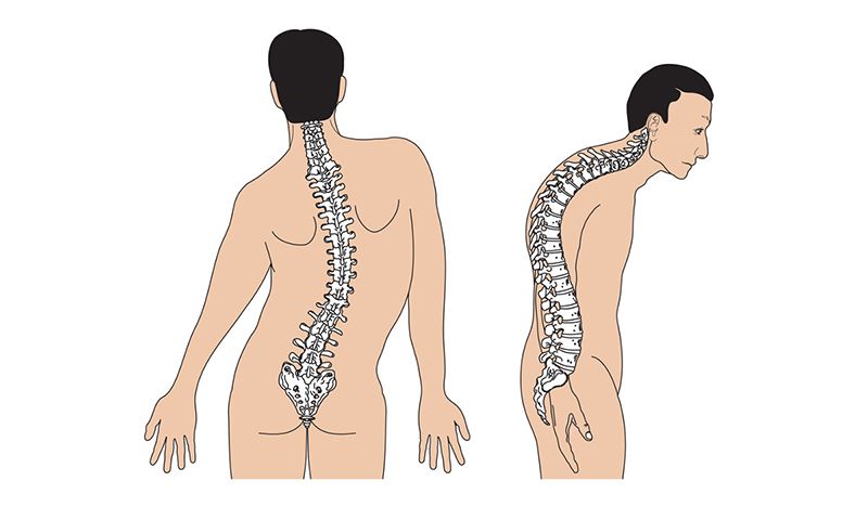 Cột sống vẹo, gù do biến chứng của gai cột sống thắt lưng