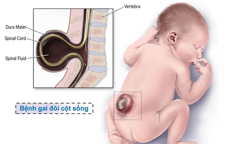 gai đôi cột sống bẩm sinh là gì