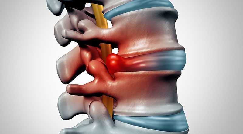 Gai xương tác động đến đĩa đệm khiến đĩa đệm bị tổn thương, gây nên bệnh thoát vị đĩa đệm