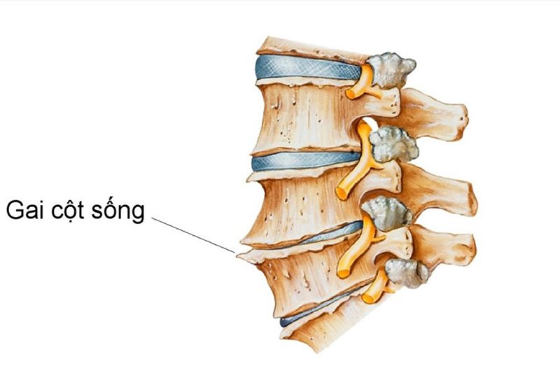 Các gai xương xuất hiện ngày càng rõ ở độ tuổi từ 20 - 50 tuổi