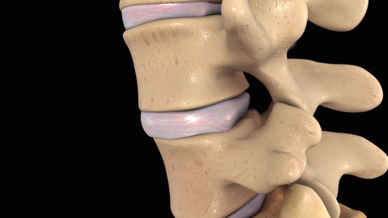 Những điều cần biết về bệnh thoát vị đĩa đệm L4 L5 