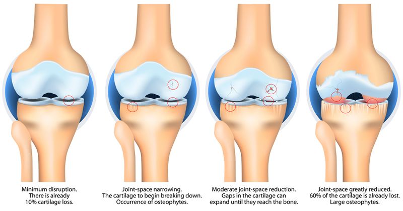 Mức độ thoái hóa khớp đầu gối theo thứ tự tăng dần