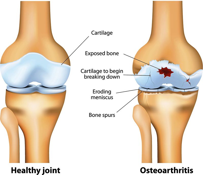 Các khớp xương theo thời gian sẽ bị bào mòn và suy yếu chức năng dẫn đến thoái hóa