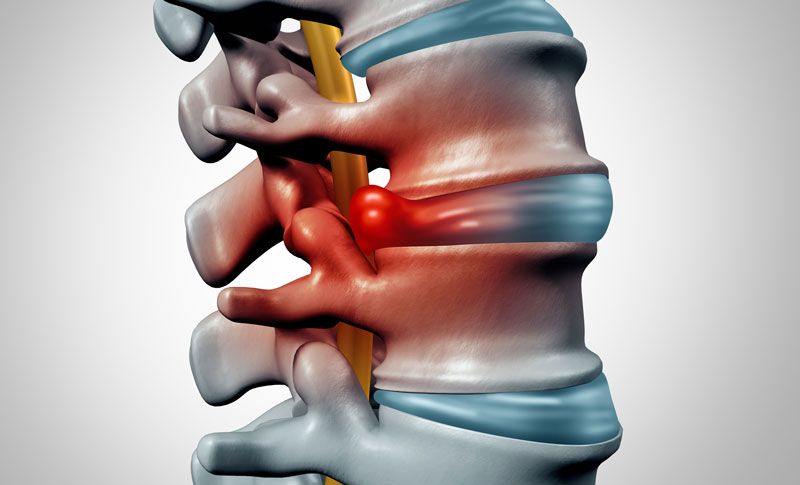 Thoát vị đĩa đệm cột sống là căn bệnh như thế nào?