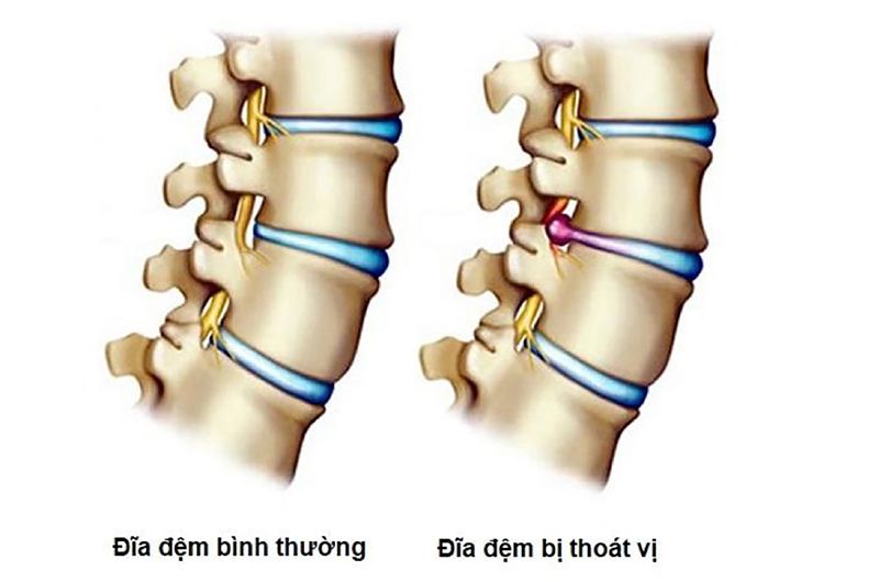 Nhân nhầy thoát ra khỏi màng gây chèn ép các rễ thần kinh