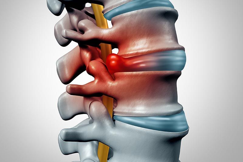 Thoát vị đĩa đệm là tình trạng đĩa đệm dịch chuyển sai lệch vị trí