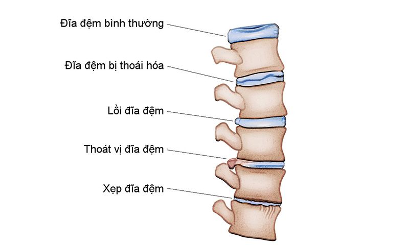 Minh họa đĩa đệm bình thường và đĩa đệm tổn thương