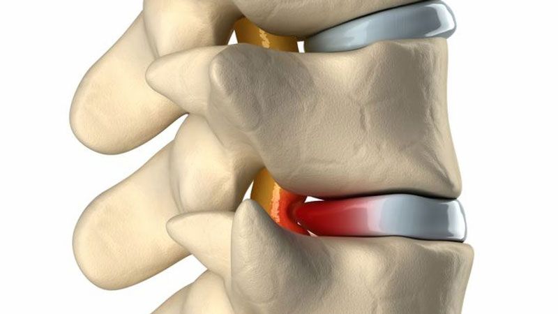 Tìm hiểu bệnh thoát vị đĩa đệm là gì?