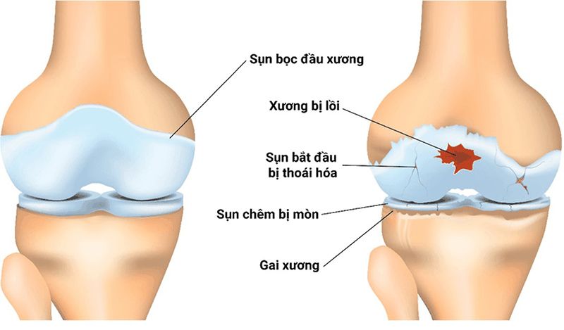 Lớp sụn xương bị tổn thương nguy cơ của bệnh viêm khớp gối