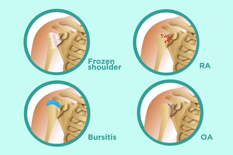 Bệnh viêm khớp vai hay còn được biết đến là bệnh viêm quanh khớp vai