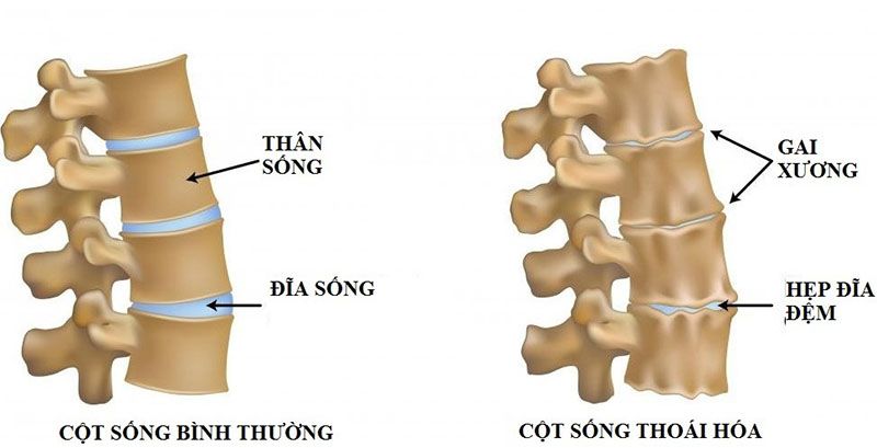 Phần đĩa tròn từ sụn nằm giữa hai đốt sống có vấn đề là nguyên nhân gây nên bệnh gai cột sống 