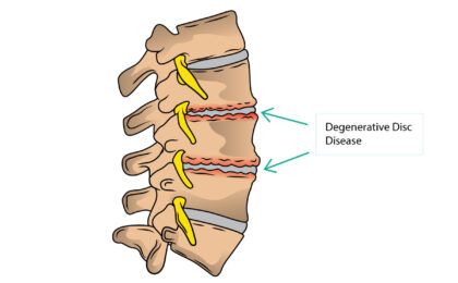 Thoái hóa cột sống – Triệu chứng và biến chứng nguy hiểm