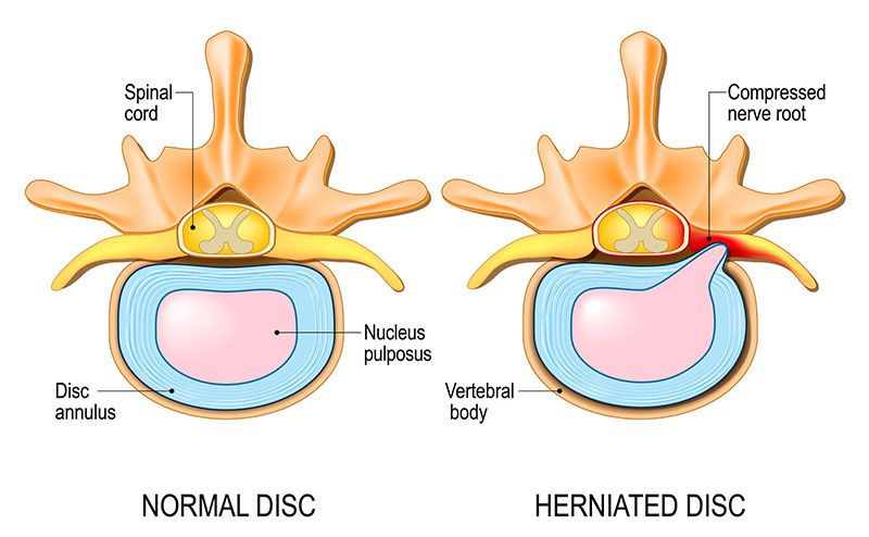Hình ảnh so sánh giữa đĩa đệm bình thường và đĩa đệm bị thoát vị