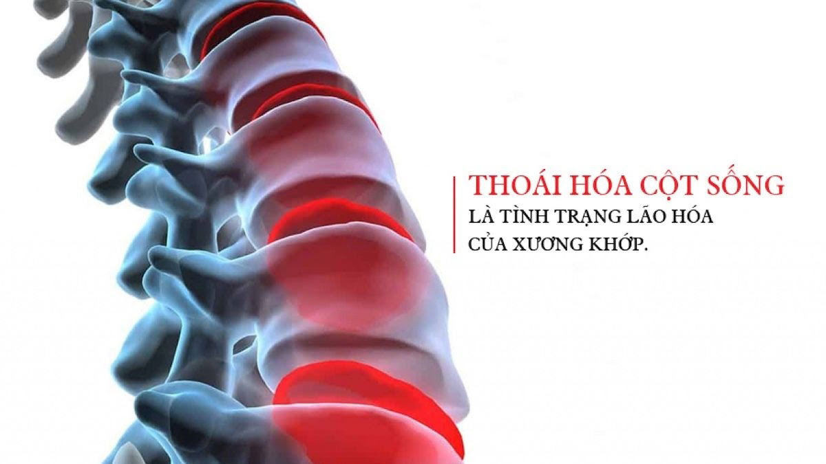 Thoái hóa cột sống