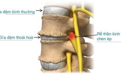 Những thông tin cần biết về căn bệnh thoái hóa đĩa đệm