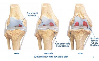 Yếu tố nguy cơ và biểu hiện của thoái hóa xương khớp