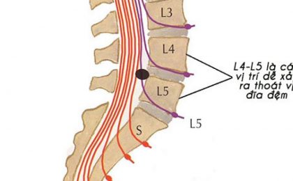 Phương pháp điều trị thoát vị đĩa đệm cột sống thắt lưng l4 l5