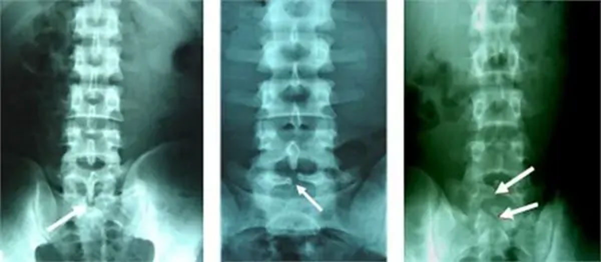 Gai đôi cột sống: Bạn đang gặp vấn đề với đau lưng do gai đôi cột sống? Hãy xem ngay hình ảnh liên quan để hiểu thêm về nguyên nhân và cách điều trị chính xác nhất.