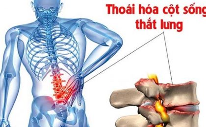 Thoái hóa cột sống thắt lưng là gì? Nguyên nhân và triệu chứng của bệnh