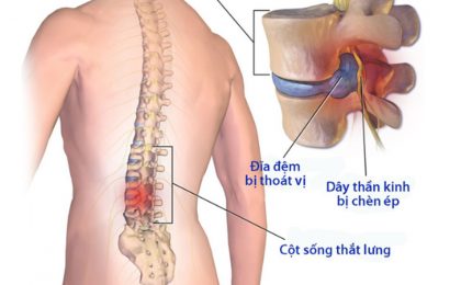 Các phương pháp điều trị thoái hóa cột sống thắt lưng