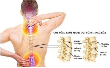 Thoái hóa cột sống là gì? Điều trị thế nào hiệu quả?