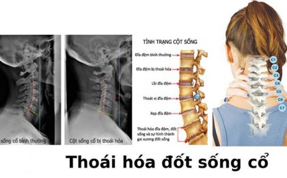 Bị thoái hóa đốt sống cổ nên ăn và kiêng những thực phẩm gì?