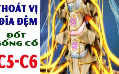 Thoát vị đĩa đệm cột sống cổ C5 C6: Chẩn đoán, phương pháp điều trị