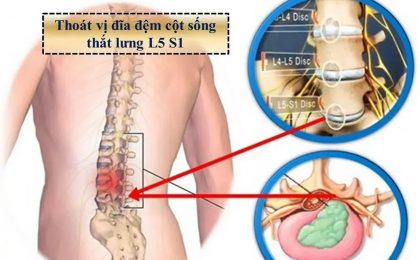 Thoát vị đĩa đệm cột sống thắt lưng l4 l5 và những thông tin tổng quan