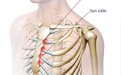 Viêm khớp sụn sườn là gì? Triệu chứng và điều trị thế nào?