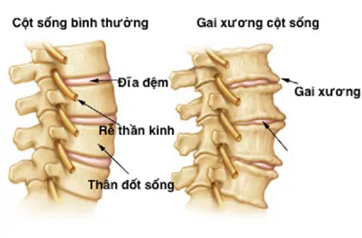 benh-gai-cot-song-phai-lam-sao_13