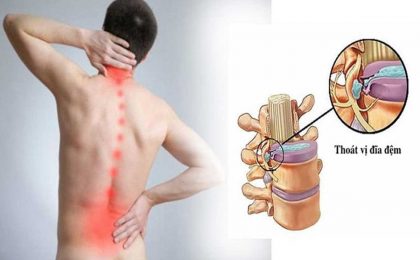 Bị thoát vị đĩa đệm nên tập gì để hỗ trợ điều trị bệnh?