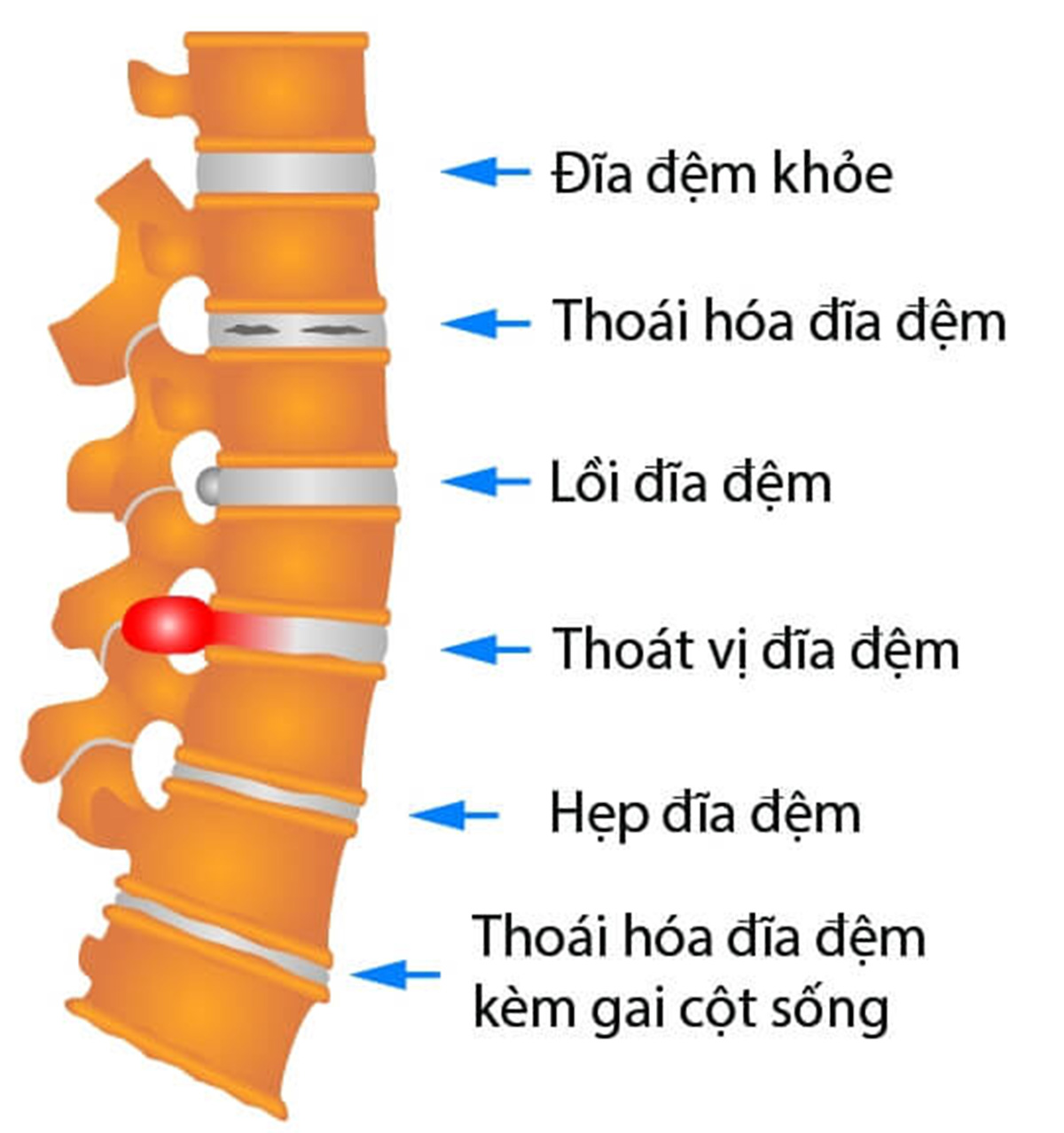 bi-thoat-vi-dia-dem-an-gi_1