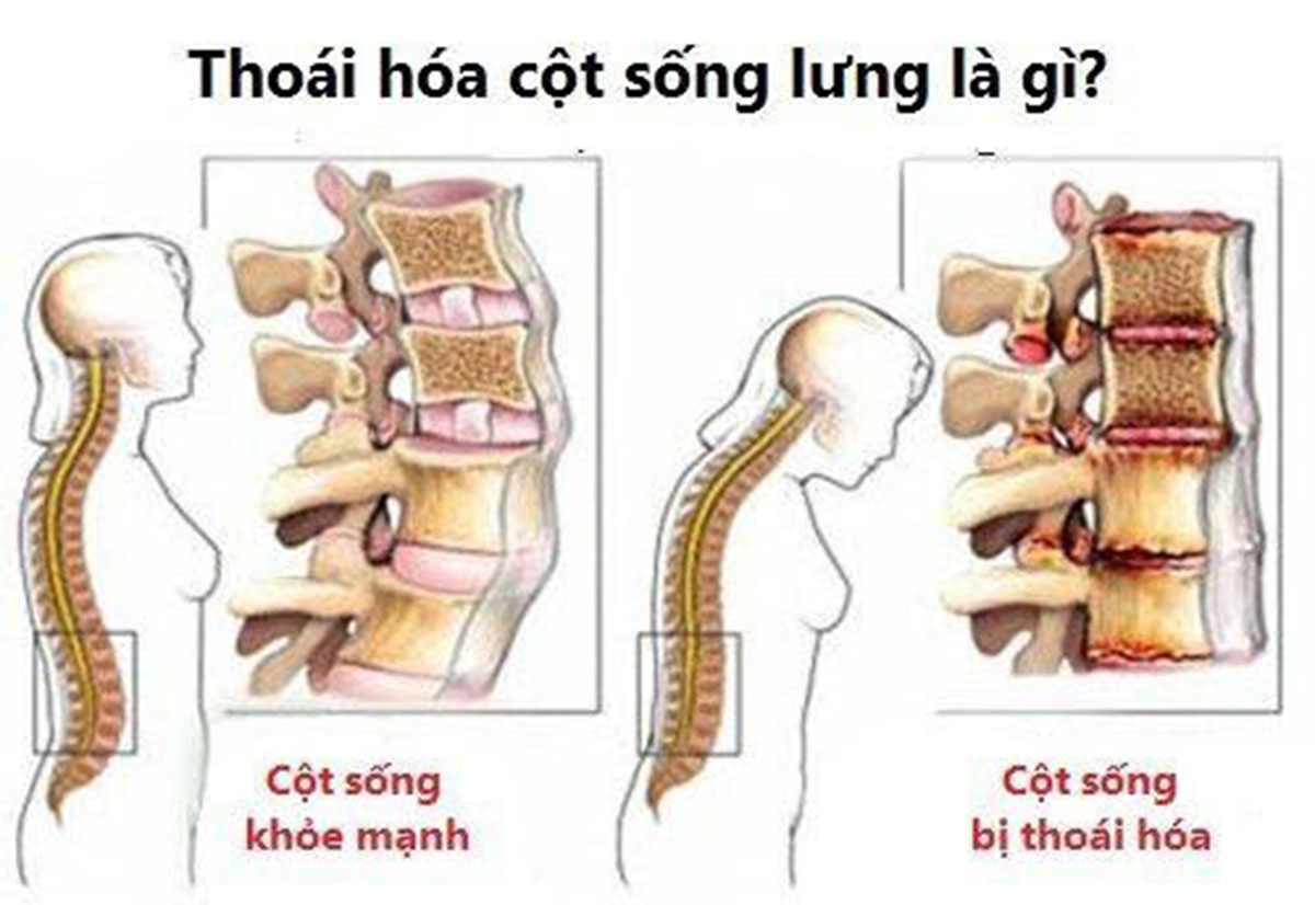 4. Triệu Chứng và Ảnh Hưởng của Thoái Hóa