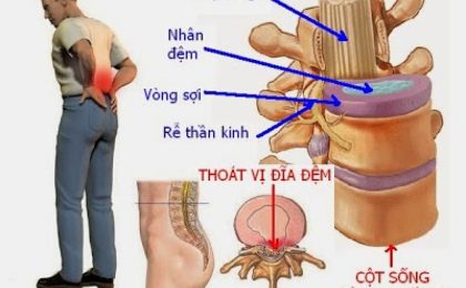 Nguyên nhân và cách phòng ngừa thoái hóa đĩa đệm cột sống thắt lưng