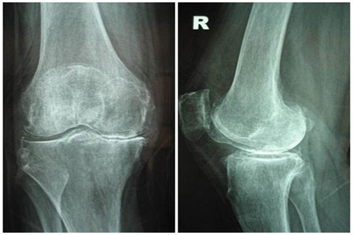 Hình ảnh X-quang thoái hóa khớp gối có tác dụng gì trong chẩn đoán ...
