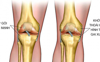 Những kiến thức quan trọng về bệnh thoái hóa khớp gối