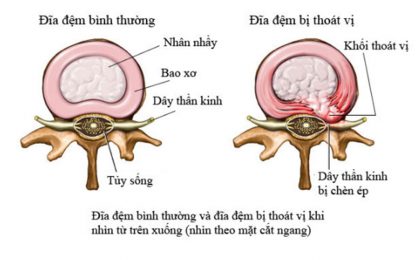 Thoái hóa thoát vị đĩa đệm: Nguyên nhân, triệu chứng, cách điều trị