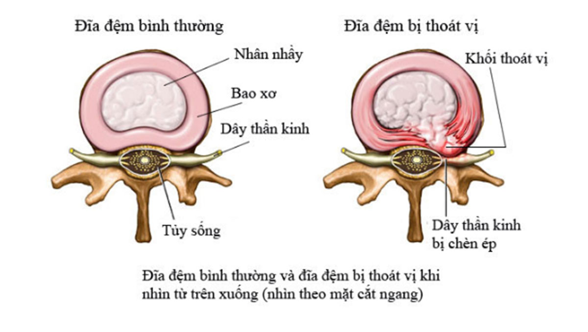 thoai-hoa-thoat-vi-dia-dem_1