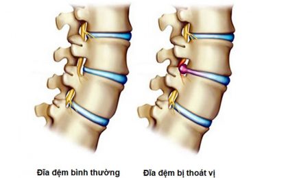 Thoát vị đĩa đệm có hít đất được không? Vấn đề bạn nên quan tâm