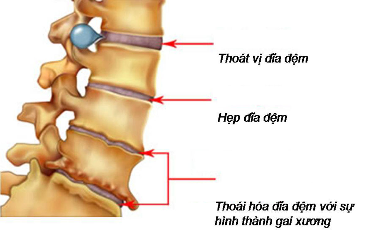 thoat-vi-dia-dem-kieng-gi_13