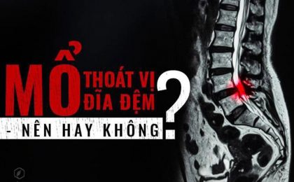 Chuyên gia giải đáp có nên mổ thoát vị đĩa đệm không?