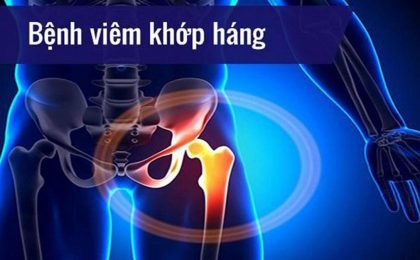 Bệnh nhân viêm khớp háng nên ăn gì để tốt nhất cho sức khỏe