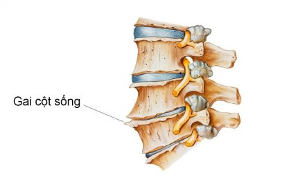 Bệnh nhân mắc gai cột sống chữa như thế nào cho hiệu quả?