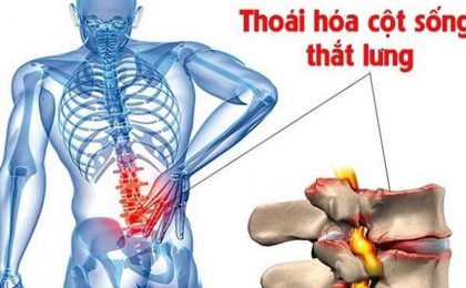 Thoái hóa cột sống thắt lưng là gì và cách điều trị bệnh