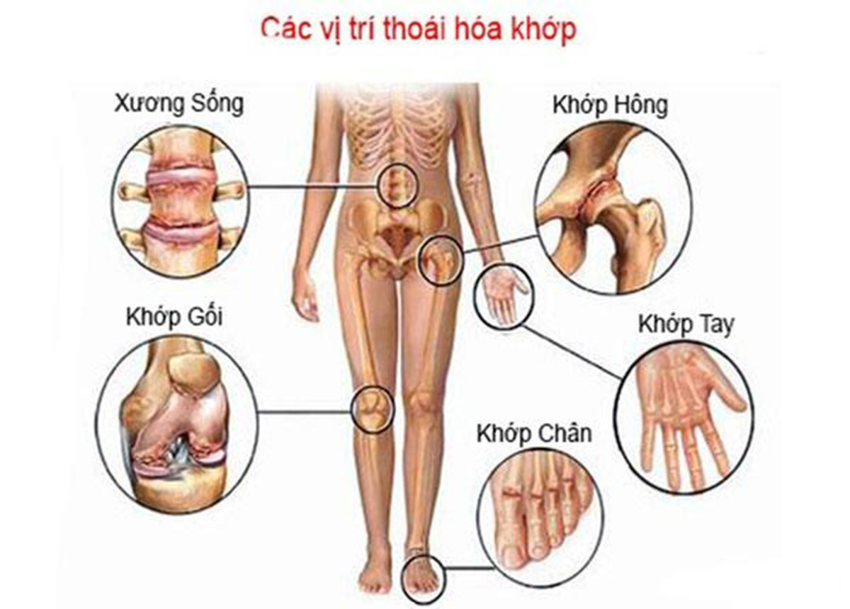 thoai-hoa-khop-benh-hoc_1