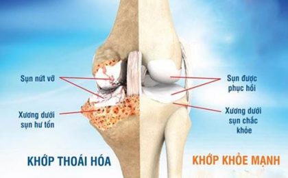 Thoái hóa khớp gối là gì? Nguyên nhân và cách chẩn đoán bệnh