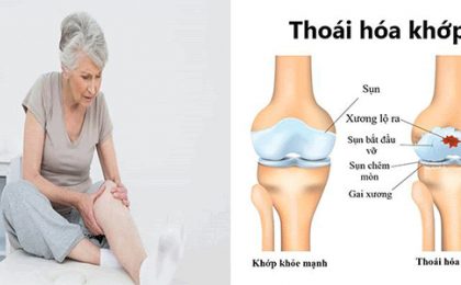 Thoái hóa khớp gối và cách điều trị bệnh hiệu quả nhất