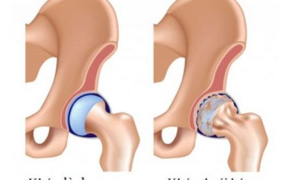 Thoái hóa khớp háng – nguyên nhân, triệu chứng và cách điều trị 