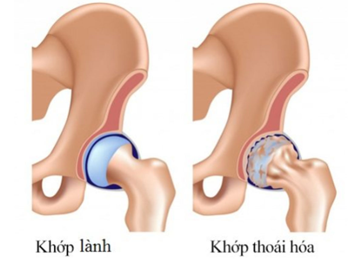 thoai-hoa-khop-hang_1