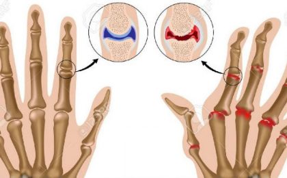 Tìm hiểu bệnh thoái hóa khớp tay do thoái hóa khớp bàn tay